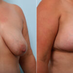 Breast Lift before and after photos in Houston, TX, Patient 54718