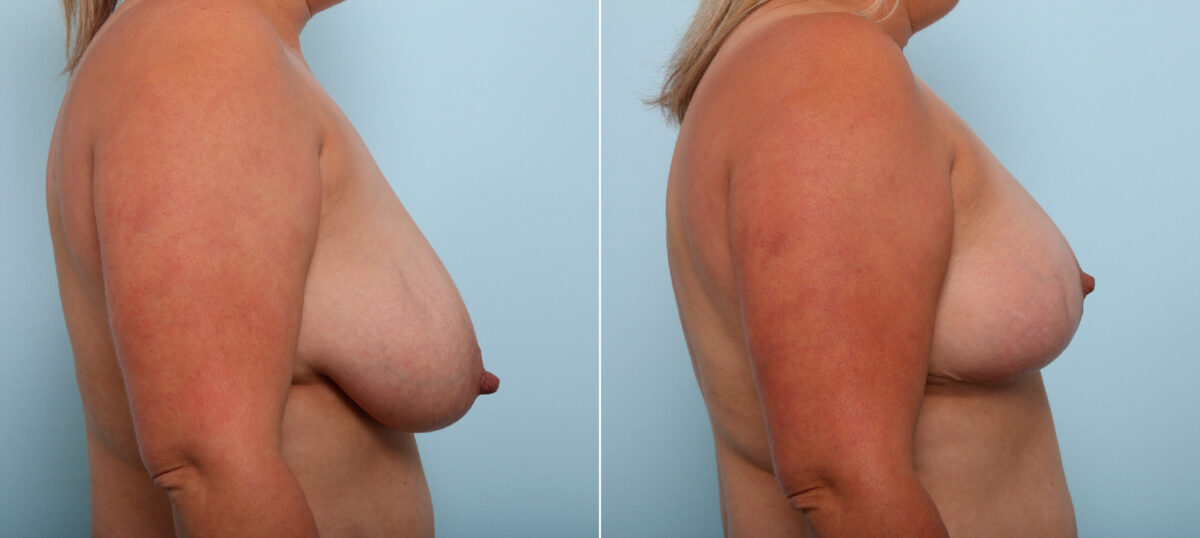 Breast Lift before and after photos in Houston, TX, Patient 54718