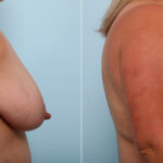 Breast Lift before and after photos in Houston, TX, Patient 54718
