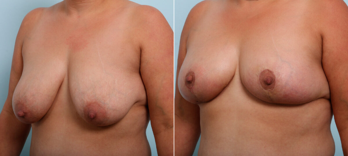 Breast Lift before and after photos in Houston, TX, Patient 54718