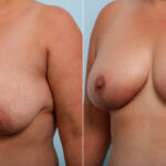 Breast Lift before and after photos in Houston, TX, Patient 54718