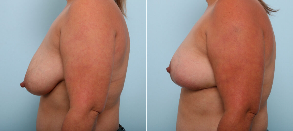 Breast Lift before and after photos in Houston, TX, Patient 54718