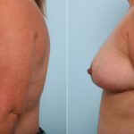 Breast Lift before and after photos in Houston, TX, Patient 54718