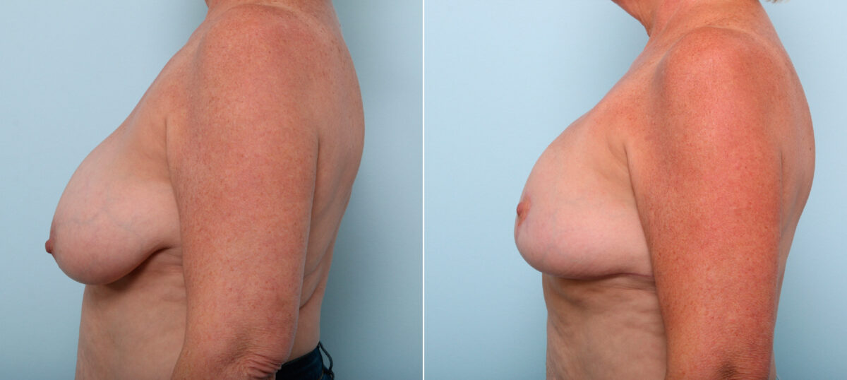 Breast Lift before and after photos in Houston, TX, Patient 54756