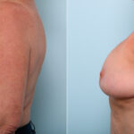 Breast Lift before and after photos in Houston, TX, Patient 54756