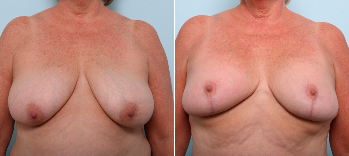 Breast Lift before and after photos in Houston, TX, Patient 54756