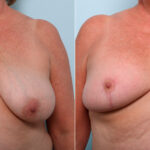Breast Lift before and after photos in Houston, TX, Patient 54756
