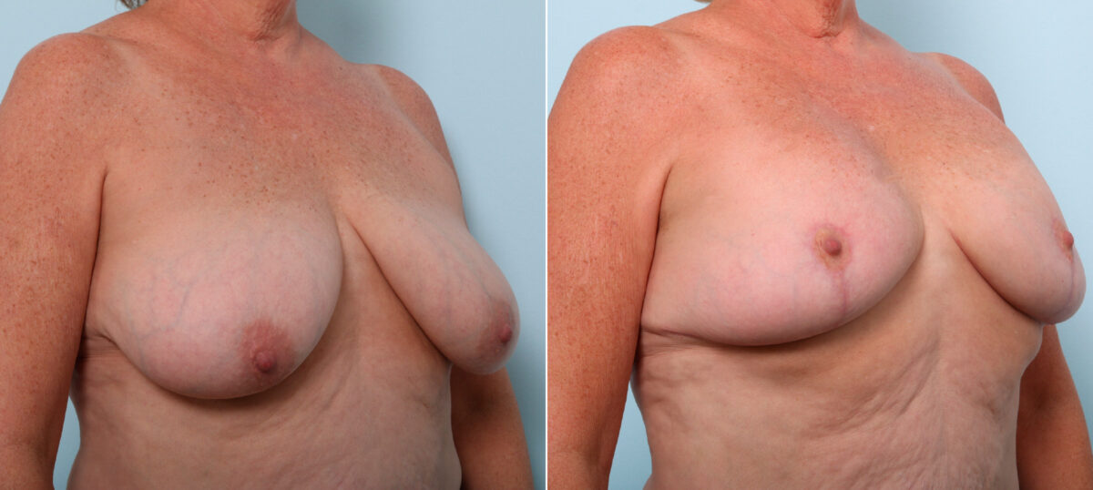 Breast Lift before and after photos in Houston, TX, Patient 54756