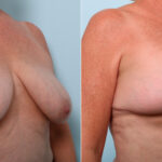 Breast Lift before and after photos in Houston, TX, Patient 54756