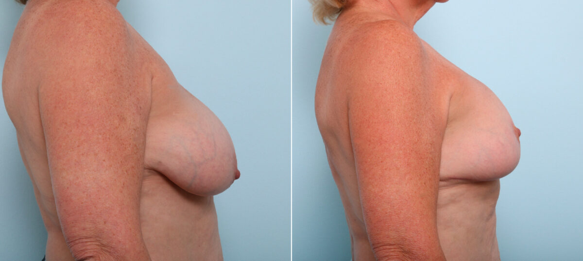 Breast Lift before and after photos in Houston, TX, Patient 54756