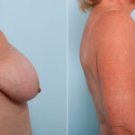 Breast Lift before and after photos in Houston, TX, Patient 54756