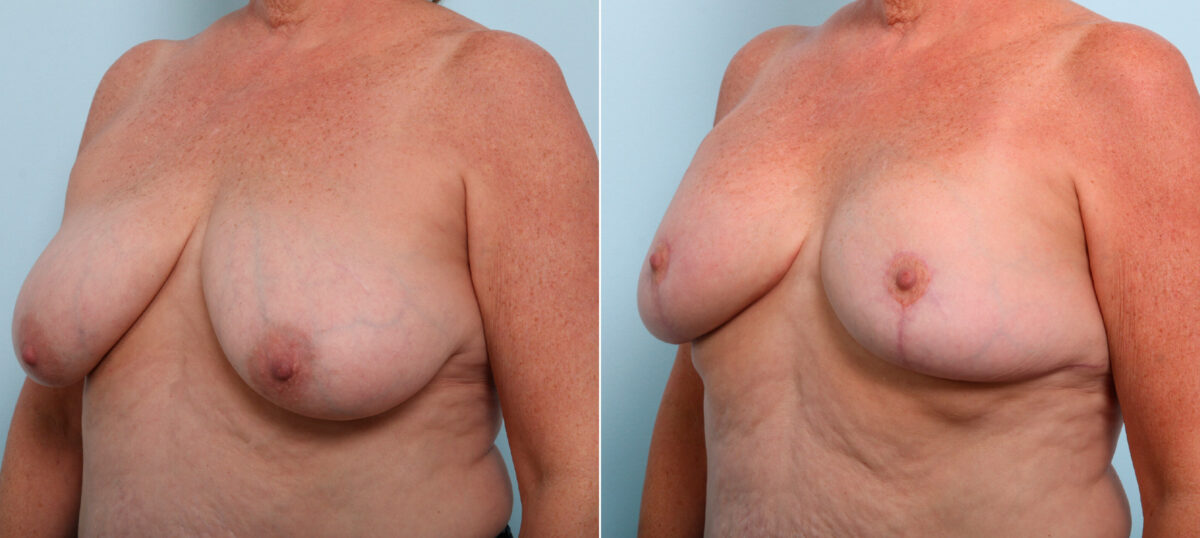 Breast Lift before and after photos in Houston, TX, Patient 54756