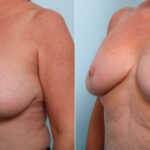 Breast Lift before and after photos in Houston, TX, Patient 54756