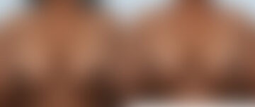 Breast Lift with Augmentation before and after photos in Houston, TX, Patient 57592