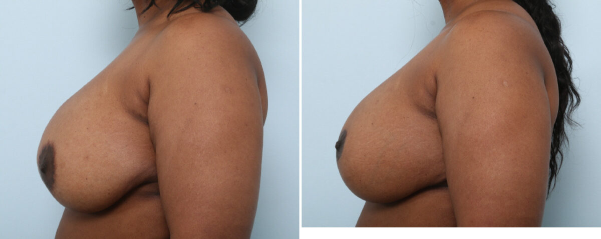 Breast Lift with Augmentation before and after photos in Houston, TX, Patient 57592