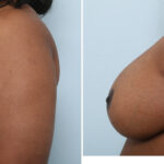 Breast Lift with Augmentation before and after photos in Houston, TX, Patient 57592