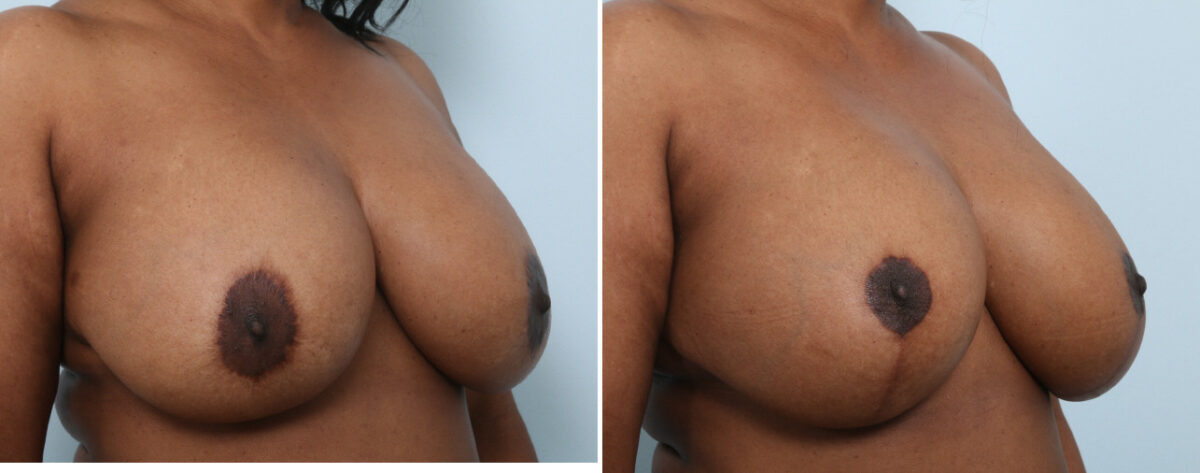 Breast Lift with Augmentation before and after photos in Houston, TX, Patient 57592