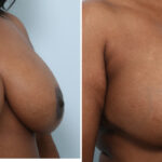 Breast Lift with Augmentation before and after photos in Houston, TX, Patient 57592