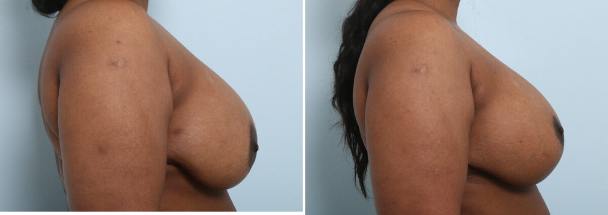 Breast Lift with Augmentation before and after photos in Houston, TX, Patient 57592