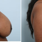 Breast Lift with Augmentation before and after photos in Houston, TX, Patient 57592