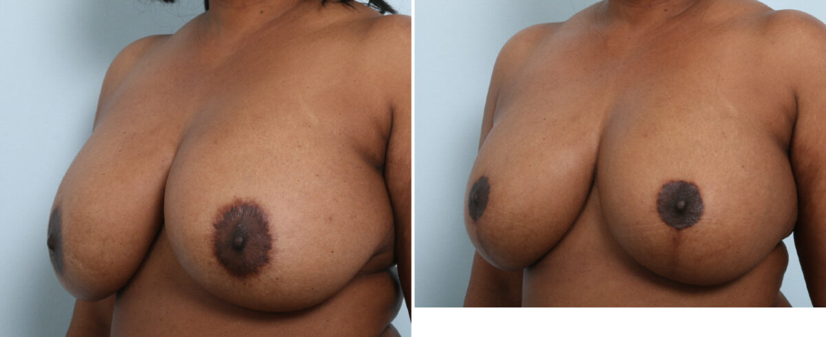 Breast Lift with Augmentation before and after photos in Houston, TX, Patient 57592