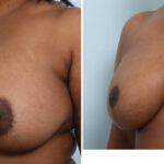 Breast Lift with Augmentation before and after photos in Houston, TX, Patient 57592