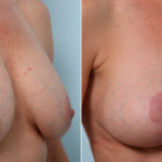 Breast Lift before and after photos in Houston, TX, Patient 57619