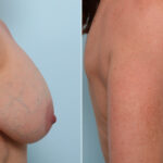 Breast Lift before and after photos in Houston, TX, Patient 57619