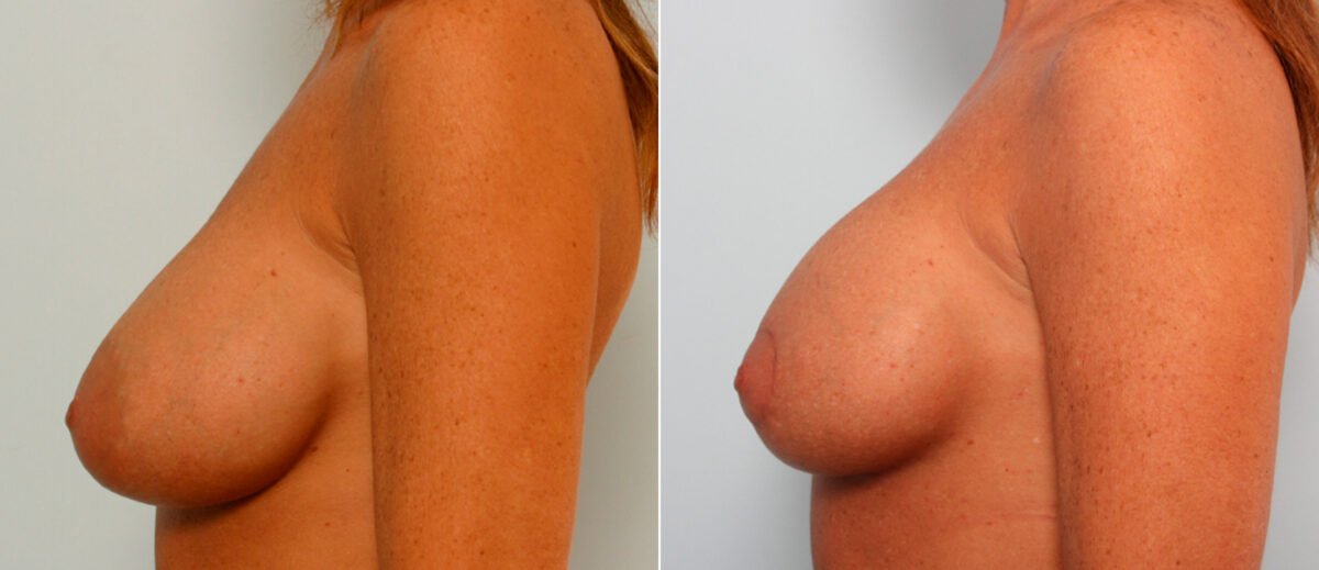 Breast Lift with Augmentation before and after photos in Houston, TX, Patient 57636