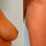 Breast Lift with Augmentation before and after photos in Houston, TX, Patient 57636