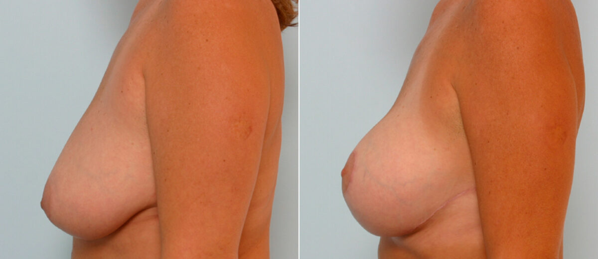 Breast Lift with Augmentation before and after photos in Houston, TX, Patient 57637