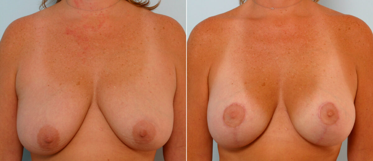 Breast Lift with Augmentation before and after photos in Houston, TX, Patient 57637