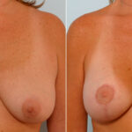 Breast Lift with Augmentation before and after photos in Houston, TX, Patient 57637