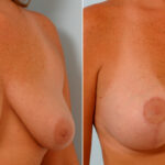 Breast Lift with Augmentation before and after photos in Houston, TX, Patient 57637