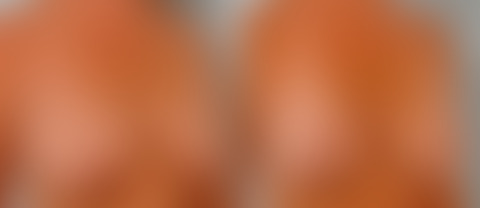 Breast Lift with Augmentation before and after photos in Houston, TX, Patient 57637