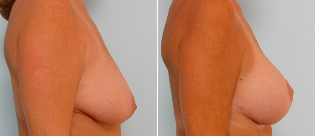 Breast Lift with Augmentation before and after photos in Houston, TX, Patient 57637