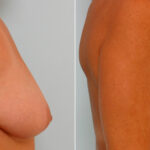 Breast Lift with Augmentation before and after photos in Houston, TX, Patient 57637