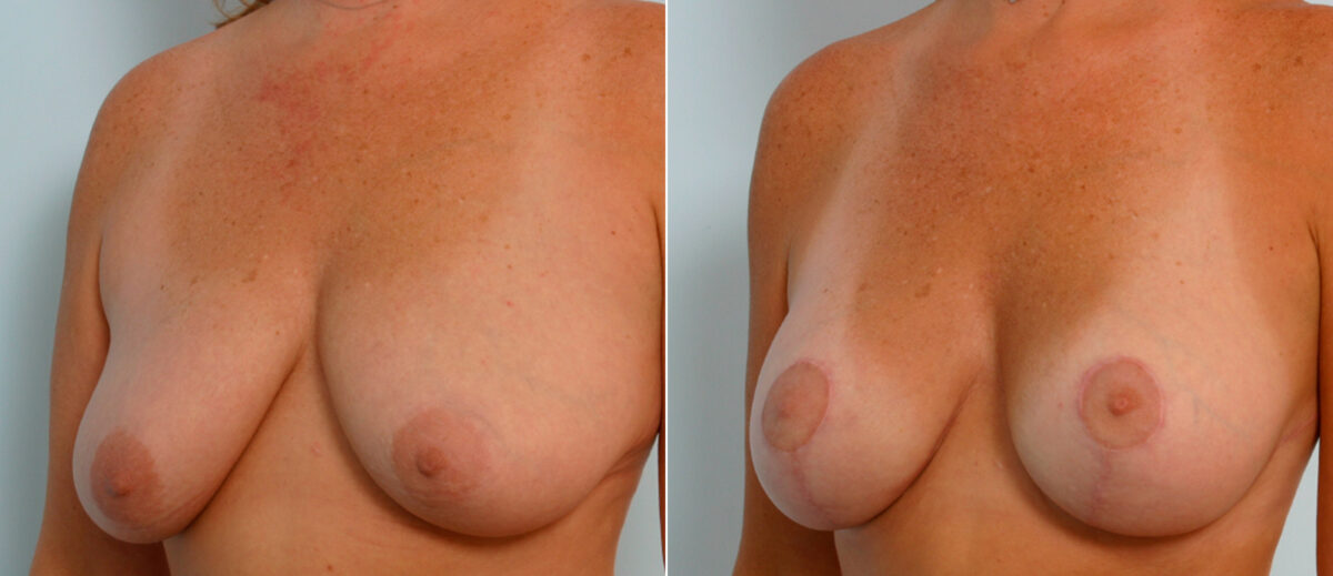 Breast Lift with Augmentation before and after photos in Houston, TX, Patient 57637