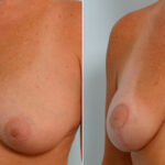 Breast Lift with Augmentation before and after photos in Houston, TX, Patient 57637