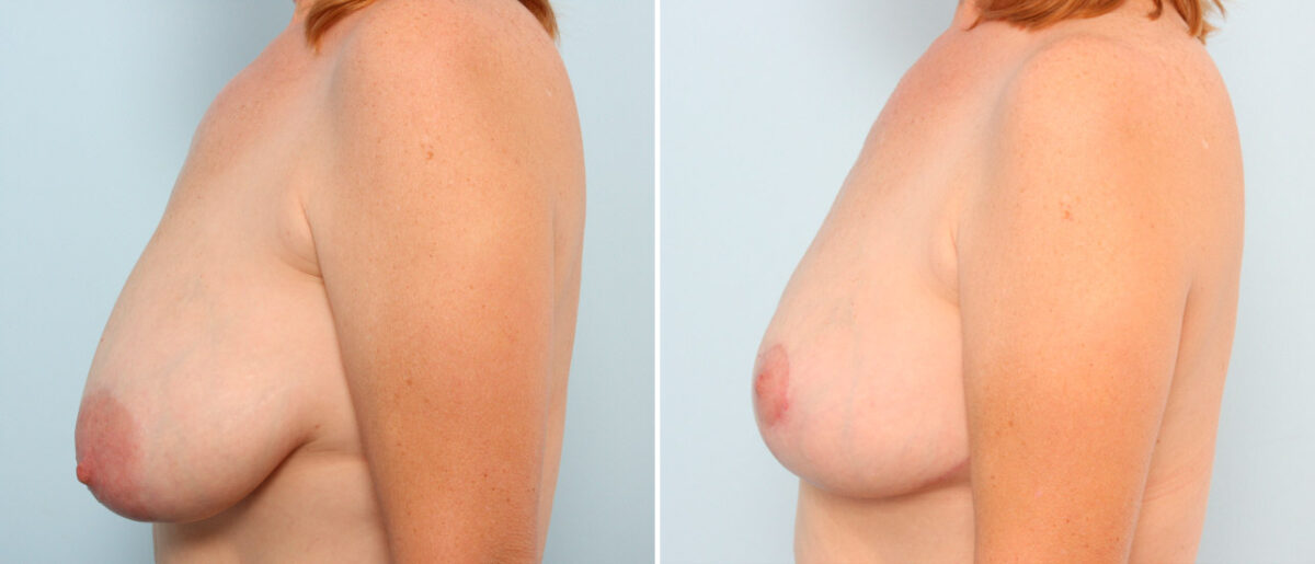 Breast Lift before and after photos in Houston, TX, Patient 57670