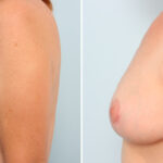 Breast Lift before and after photos in Houston, TX, Patient 57670