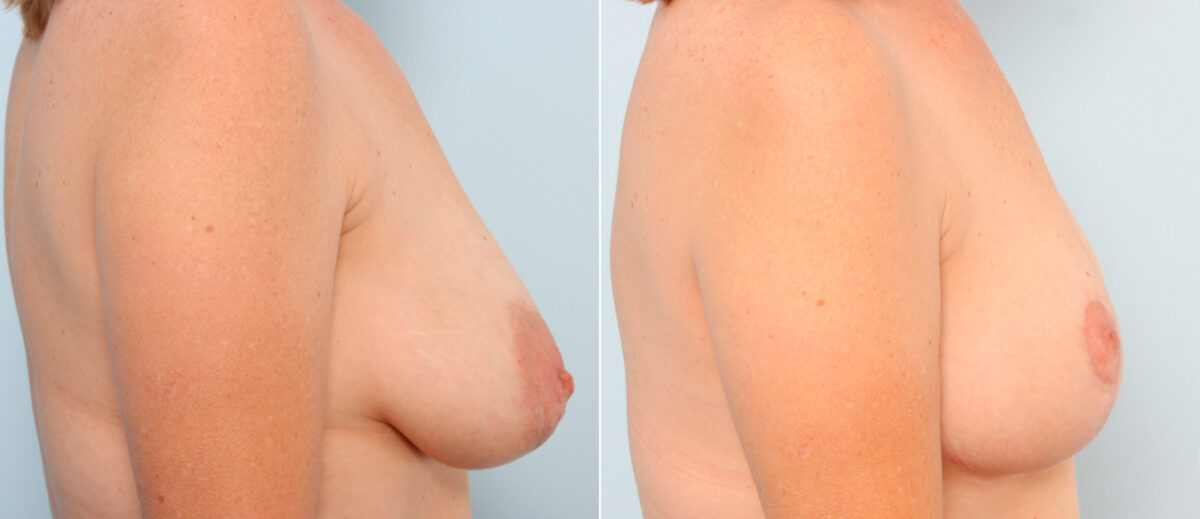 Breast Lift before and after photos in Houston, TX, Patient 57670