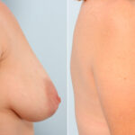 Breast Lift before and after photos in Houston, TX, Patient 57670