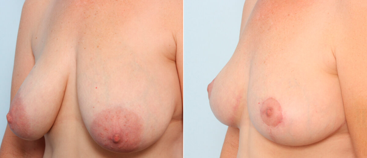 Breast Lift before and after photos in Houston, TX, Patient 57670