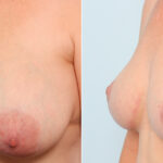 Breast Lift before and after photos in Houston, TX, Patient 57670