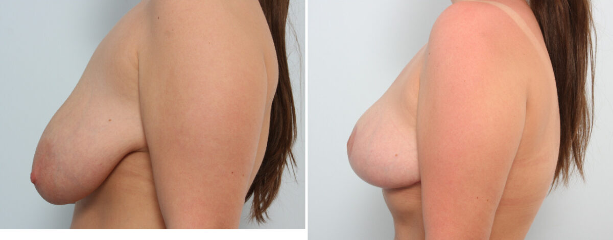 Breast Lift before and after photos in Houston, TX, Patient 57686