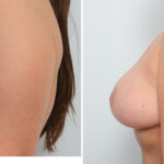 Breast Lift before and after photos in Houston, TX, Patient 57686