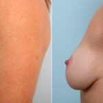 Breast Lift with Augmentation before and after photos in Houston, TX, Patient 57696
