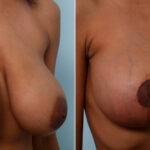 Breast Lift before and after photos in Houston, TX, Patient 57722