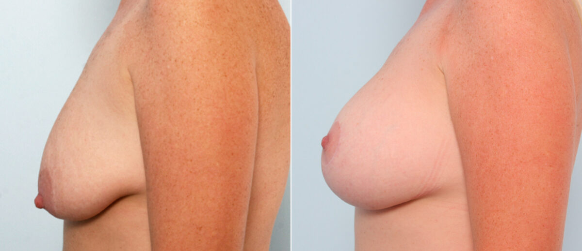 Breast Lift with Augmentation before and after photos in Houston, TX, Patient 57738